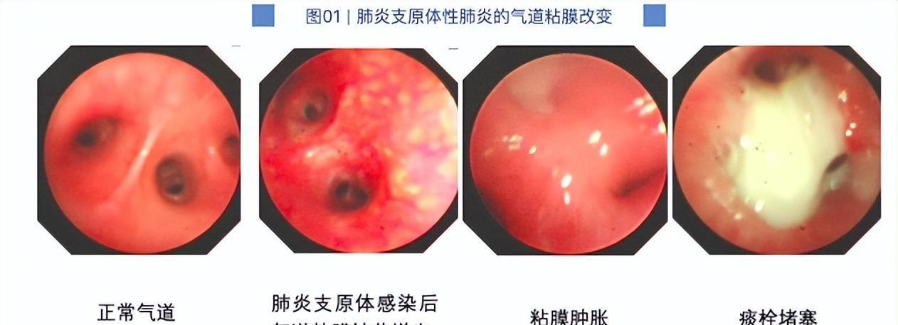 7岁男童肺部发生实变必须洗肺吗,七岁男童肺实变