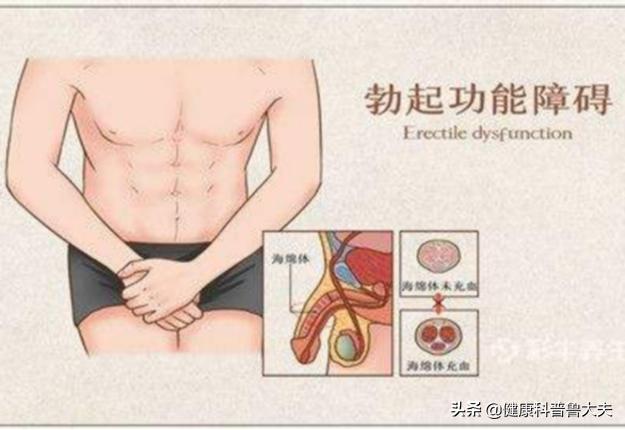 男性必看！勃起功能障碍,ED中西医融合药物治疗建议