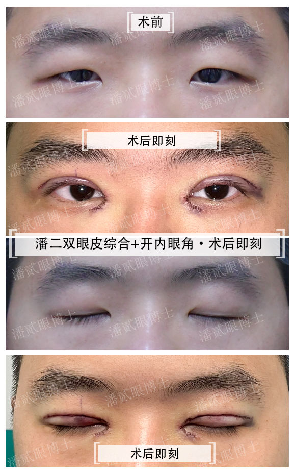 内眦赘皮用手术吗,内眼角内眦赘皮矫正不做手术