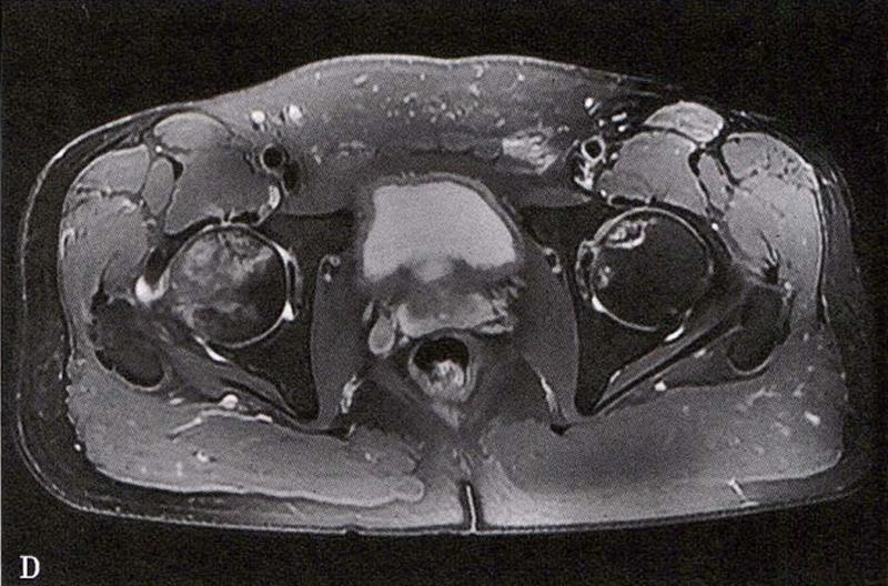 全国十大股骨头坏死诊疗中心,股骨头坏死诊疗方法有哪些