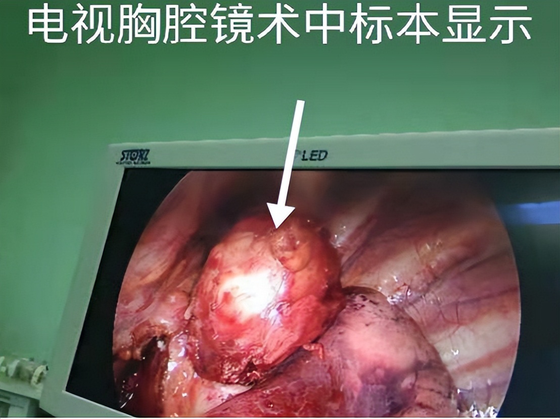 胸腔镜下胸膜冷冻活检，在胸腔积液诊断中，有价值和安全性么