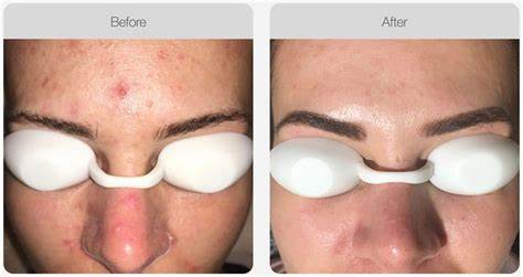 点阵激光和光子嫩肤哪个副作用小,光子嫩肤是什么作用和功效呢