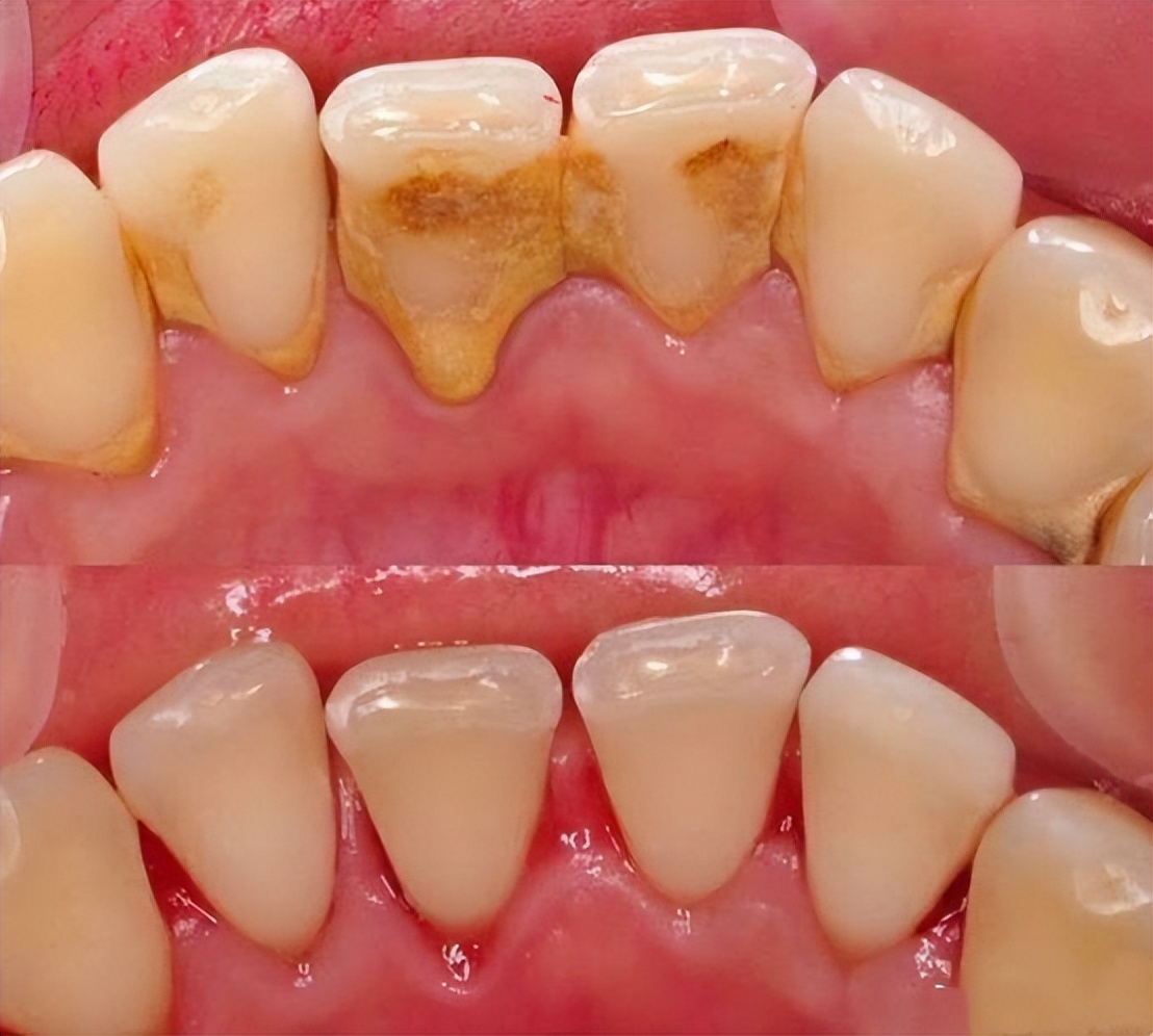 牙周炎治愈指南，这些口腔护理注意事项要牢记