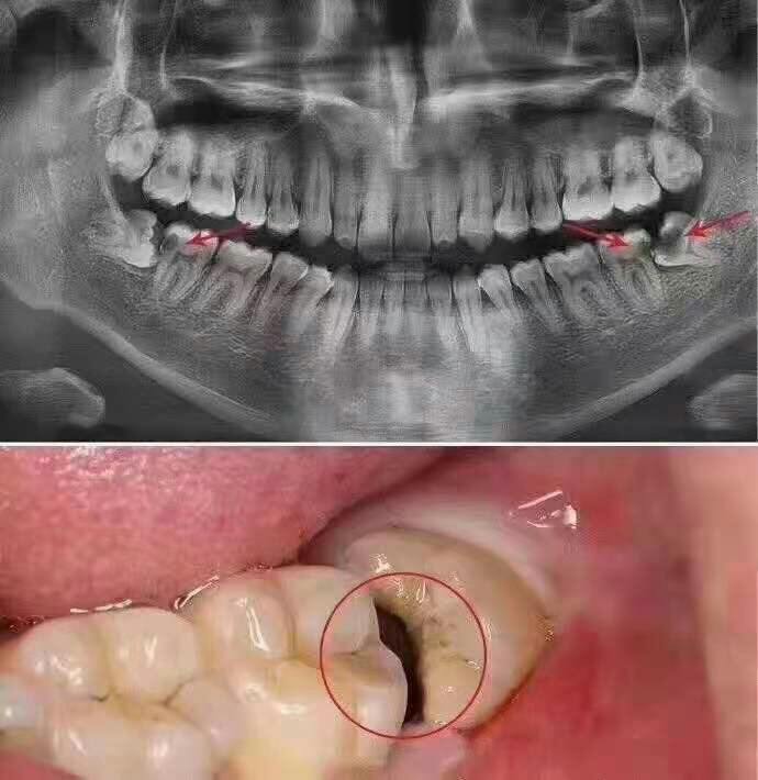 自从长了智齿，总是咬到腮帮子怎么办？专家：建议拔除