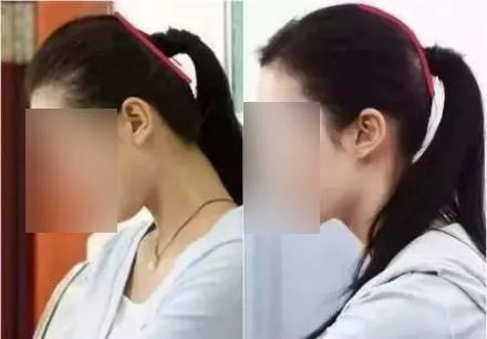 颅顶高发际线低怎么办,颅顶低降低发际线