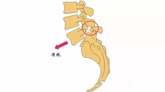 腰椎滑脱的病因,腰椎滑脱症最常见的鉴别诊断