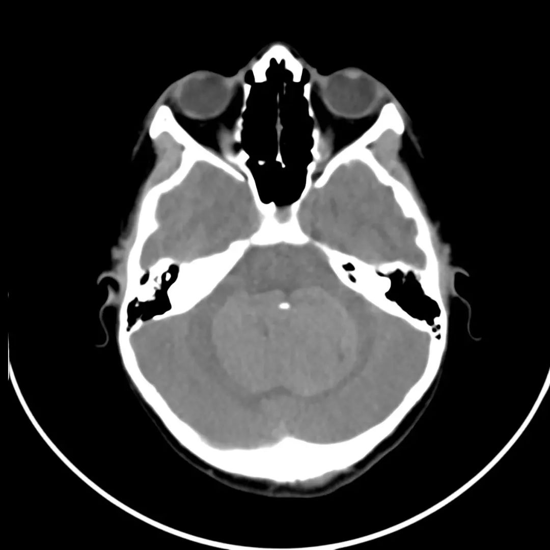 经典型髓母细胞瘤,影像诊断图片解析