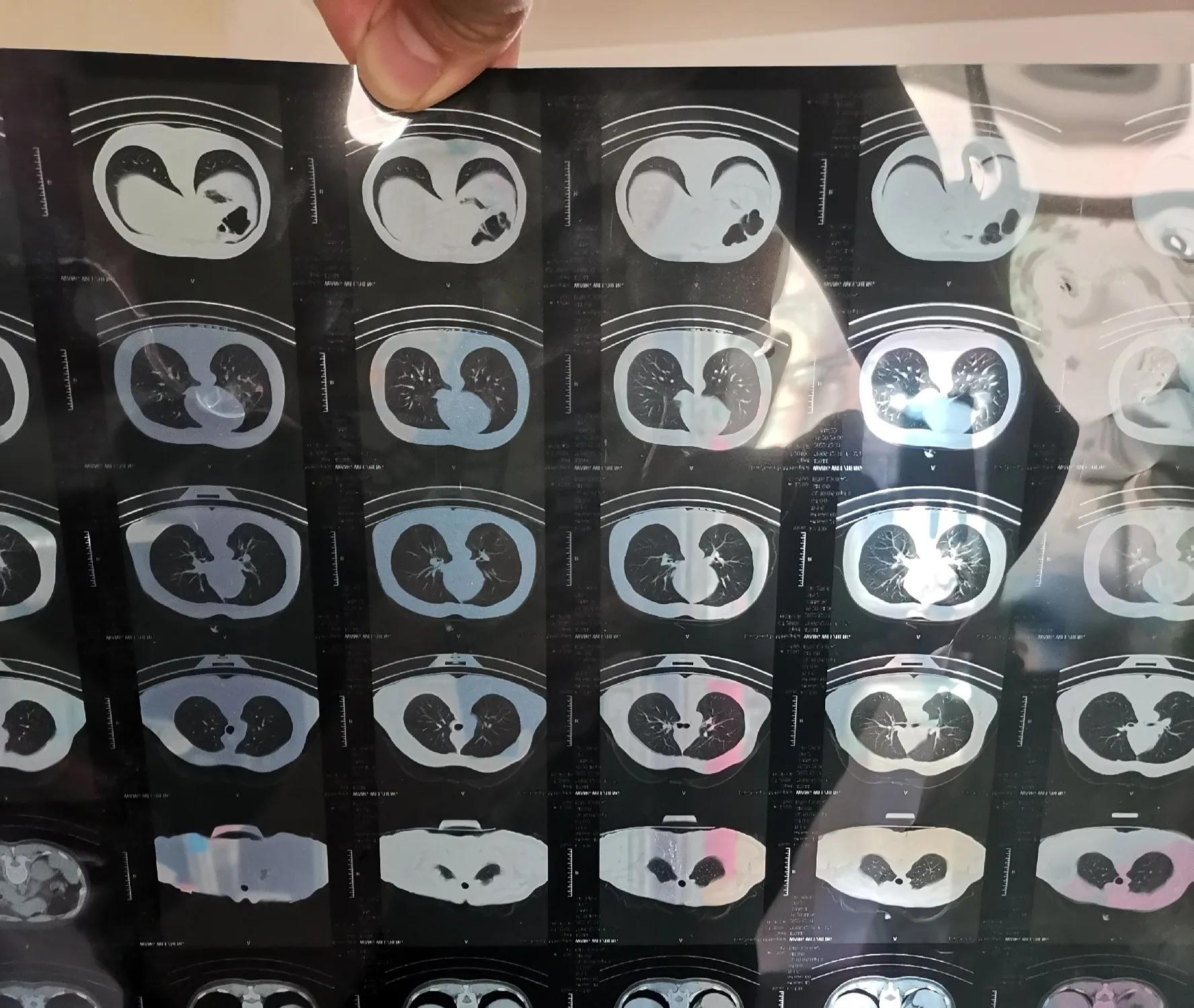 阿兹夫定对新冠有效果吗,阿兹夫定能不能治新冠病毒