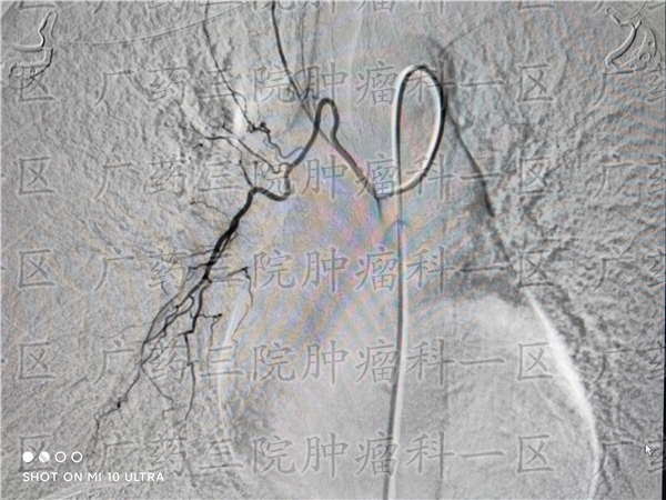 乳腺癌内分泌治疗要吃5到10年的药,乳腺癌内分泌治疗住院吗