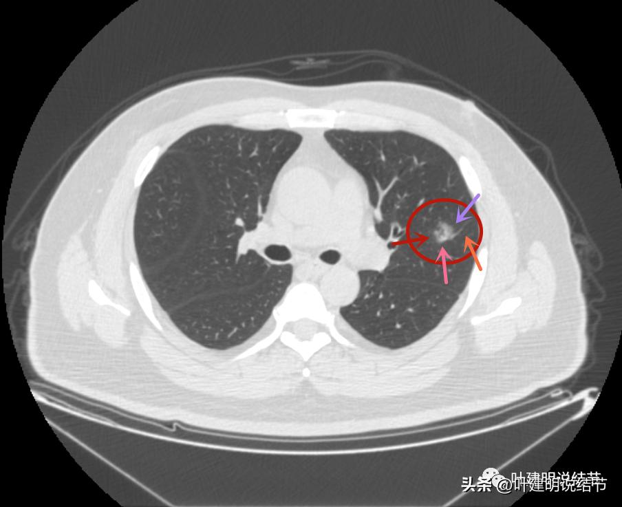 如何判断肺磨玻璃结节是高危结节,肺上有混合磨玻璃结节要注意什么
