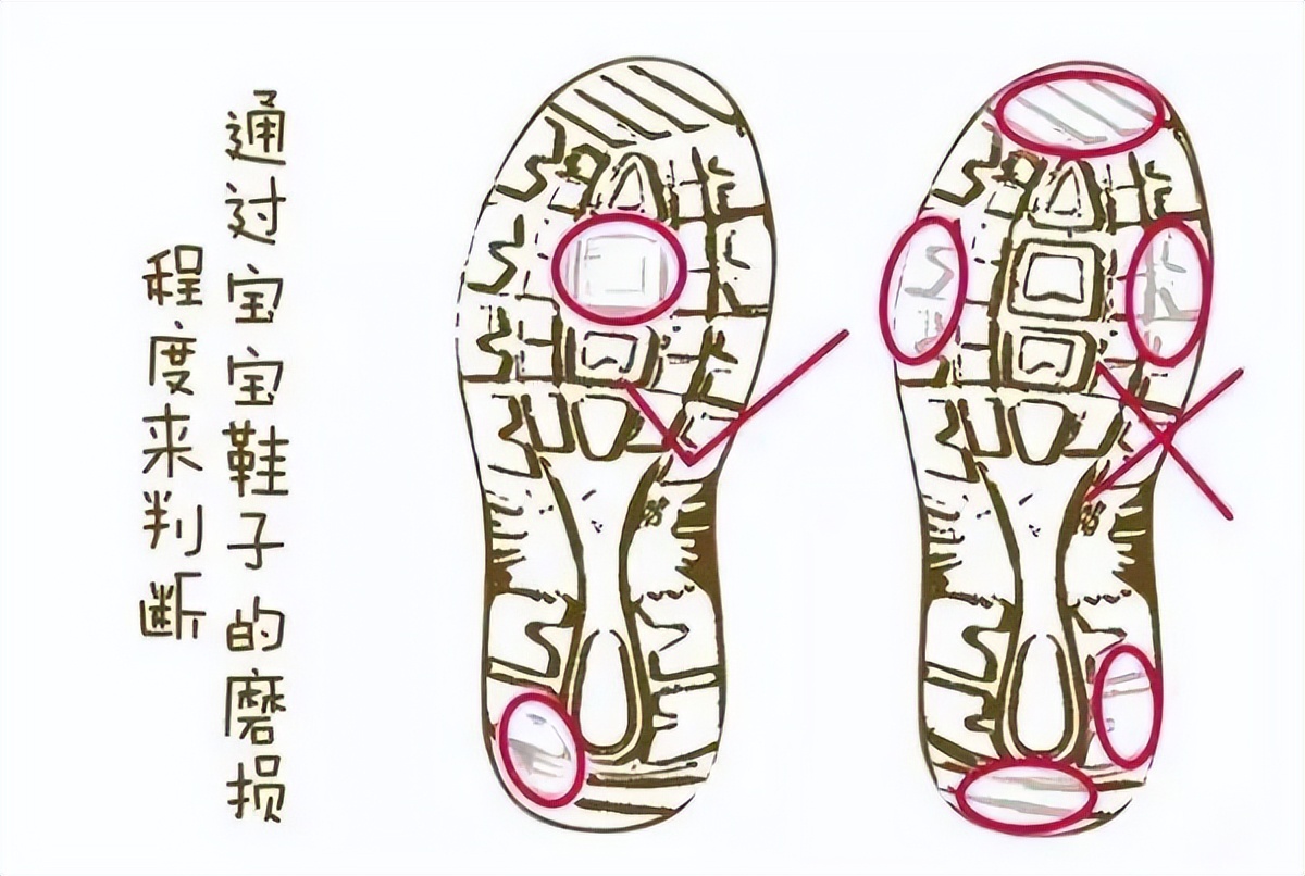 对八字走路的小孩有什么办法,小娃娃走八字怎么纠正