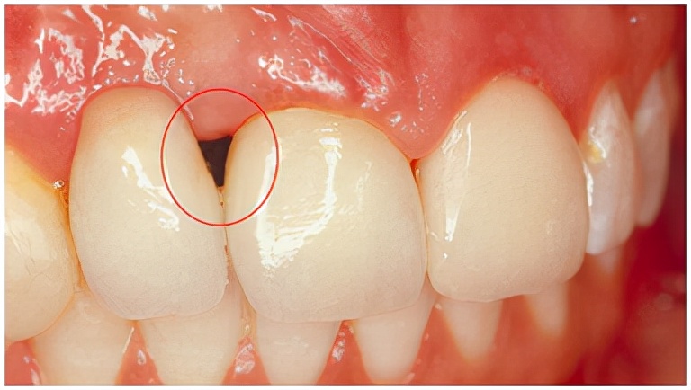 连续三颗缺牙种几颗植体最好,种植门牙3颗年轻人