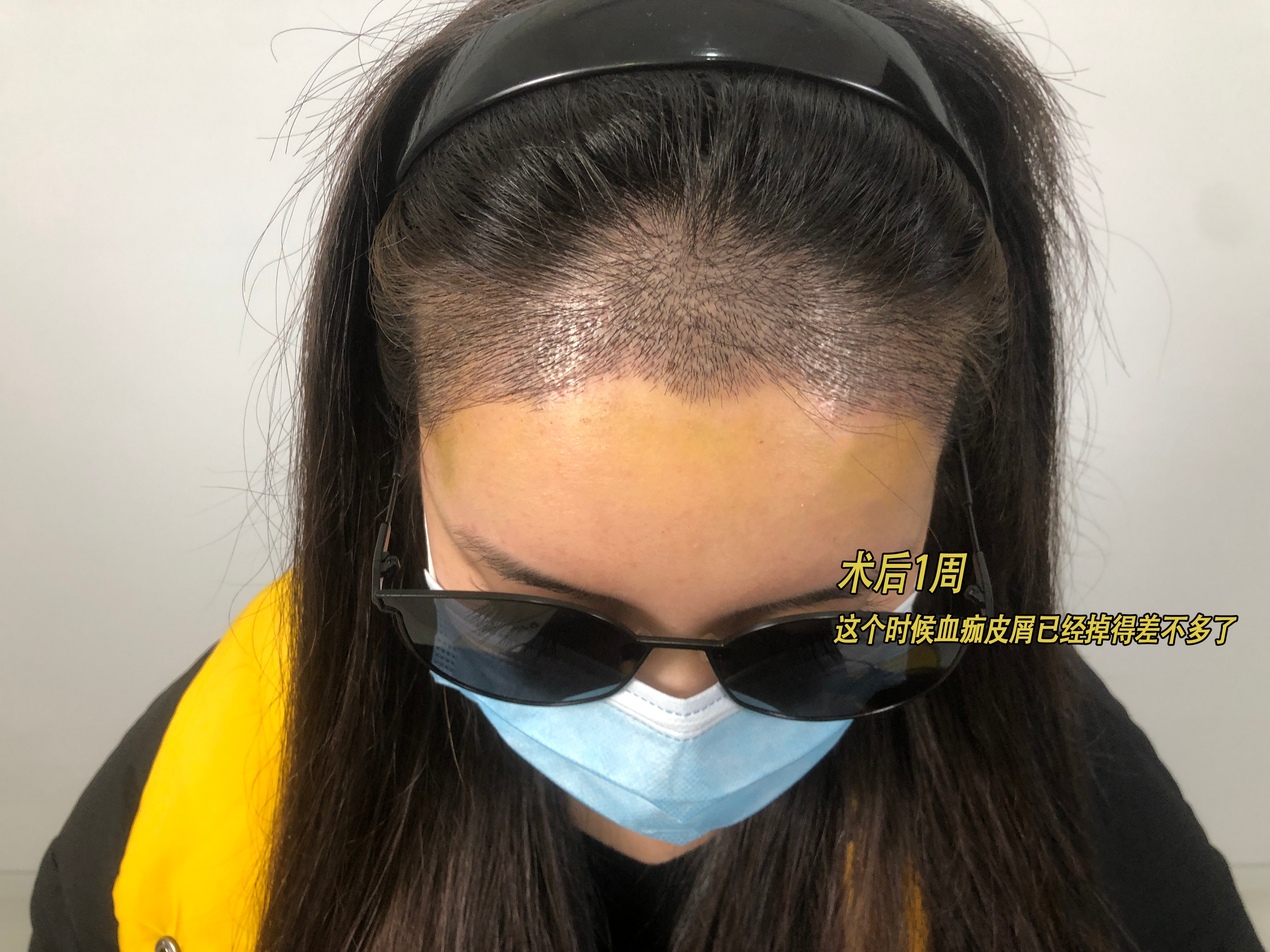 恒美植发后续,恒美植发靠谱不