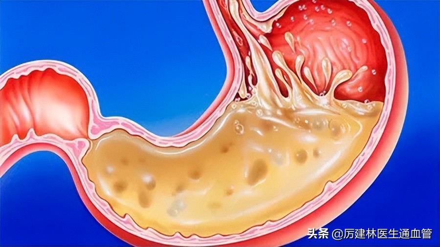 每天吃两片小苏打对痛风有好处吗,小苏打与橄榄油混合后能治痛风吗