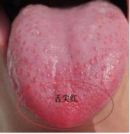 手脚心热吃六味地黄丸咋不见效呢,手脚心发热口干吃知柏地黄丸好吗