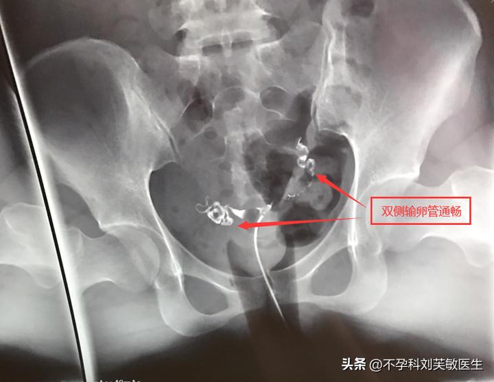 输卵管造影步骤图片解读,如何看懂输卵管造影片子