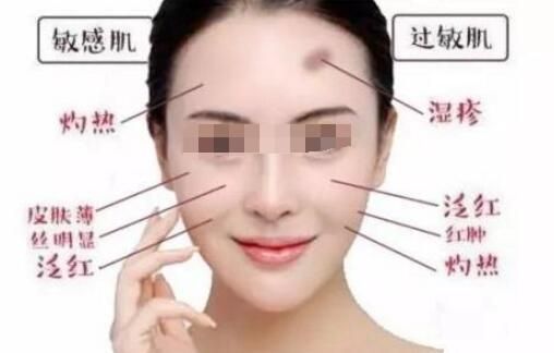 孕期脸上的痘印怎么祛除,脸上的痘印该如何祛除