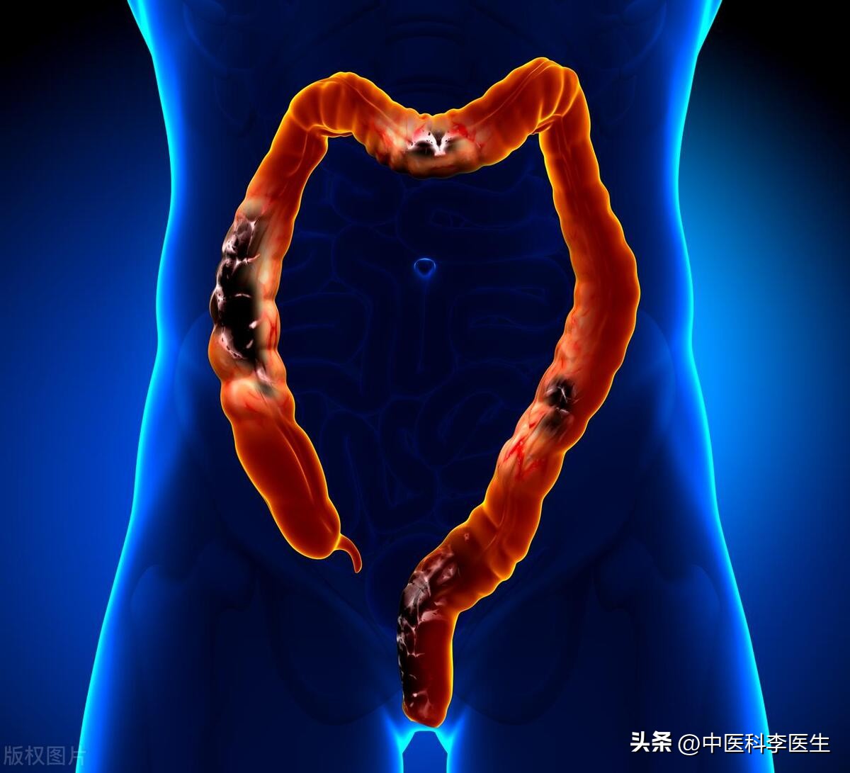 为什么这么多人最怕做肠镜,院士说肠镜一次可以保几年