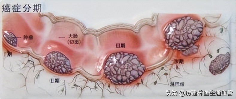 从炎症到癌症三种炎症别拖着,从炎症到癌症需要多久