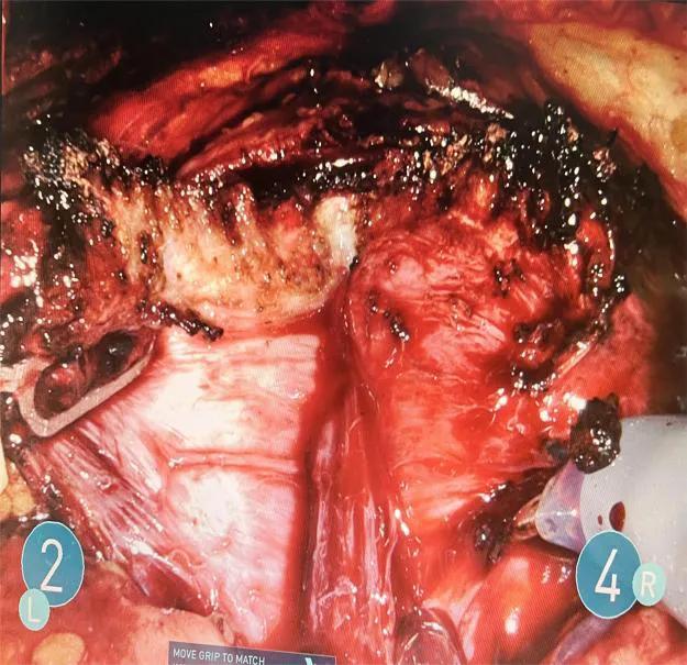 介入治疗前列腺增生效果怎么样,超微创手术治疗前列腺增生
