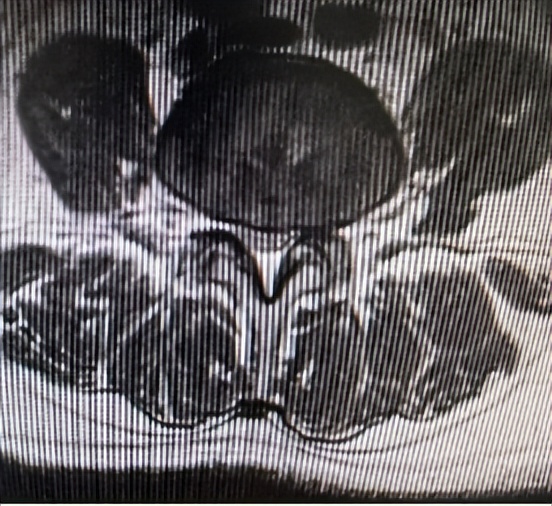门医技术|门头沟区医院骨二科成功应用微创椎间孔镜技术治疗两例腰椎管多节段狭窄症