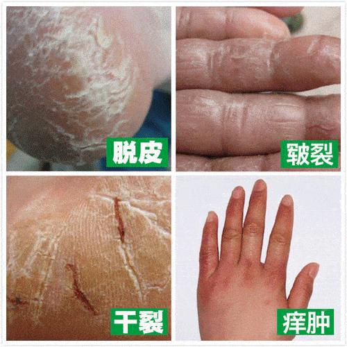 一到冬天就全身瘙痒,一到冬天全身皮肤瘙痒是什么原因