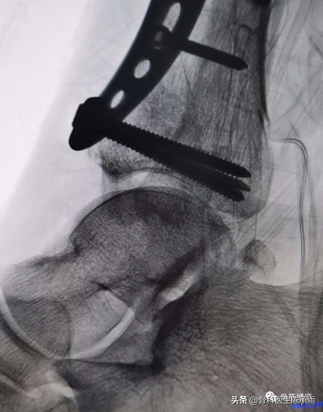 胫骨开放性骨折处理方法,胫骨腓骨开放性骨折能评几级伤残