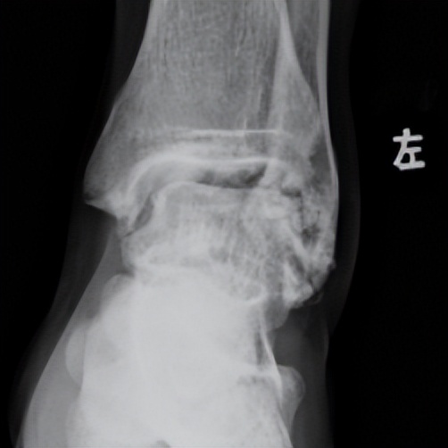 脚踝轻微扭伤如何处理,脚踝轻微扭伤用什么药物