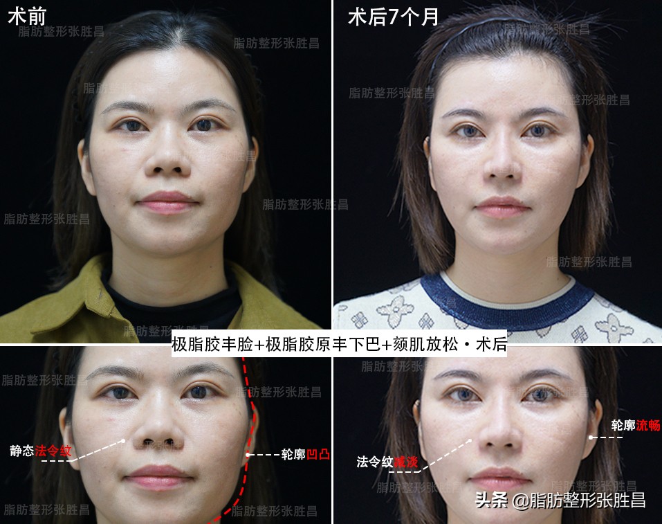 脂肪填充的真相,你不可不知道的面部脂肪填充真相