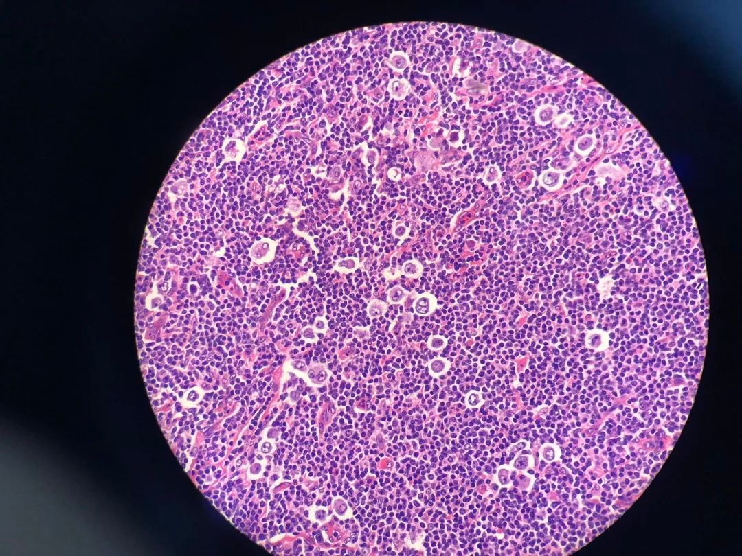 医生说病理报告有点小问题,病理报告没出来好害怕啊