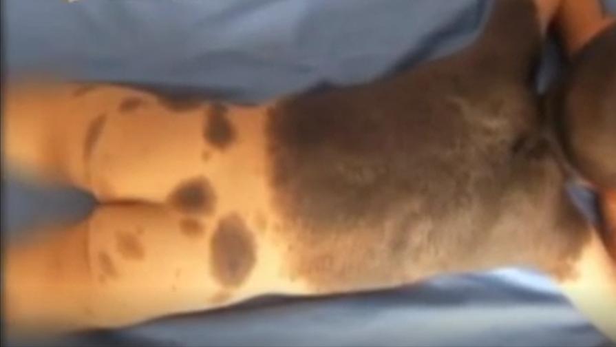 割皮救子父亲康复情况,儿子刚出生为弟弟捐骨髓后续