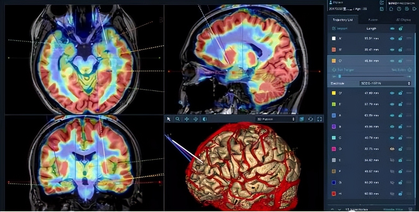 精神分裂症不能彻底治愈,为什么精神分裂症是不治之症