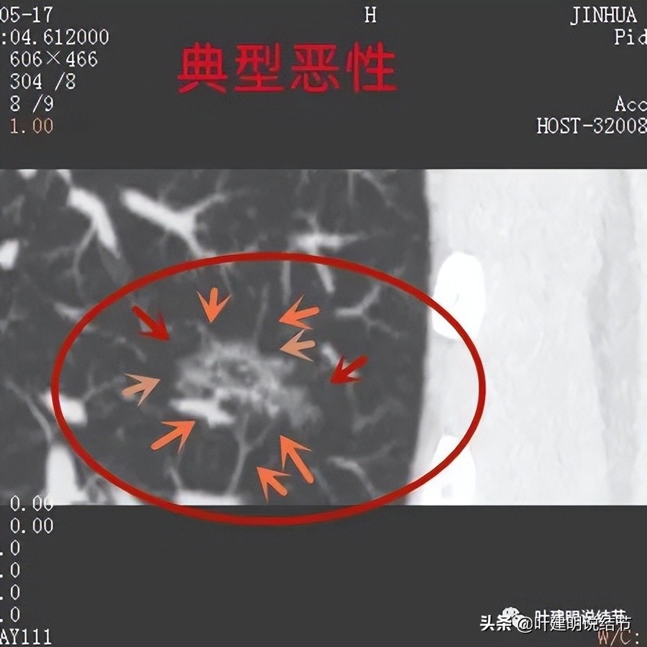 肺蜂窝状改变是肺癌吗,肺部陈旧灶与肿瘤怎么确诊