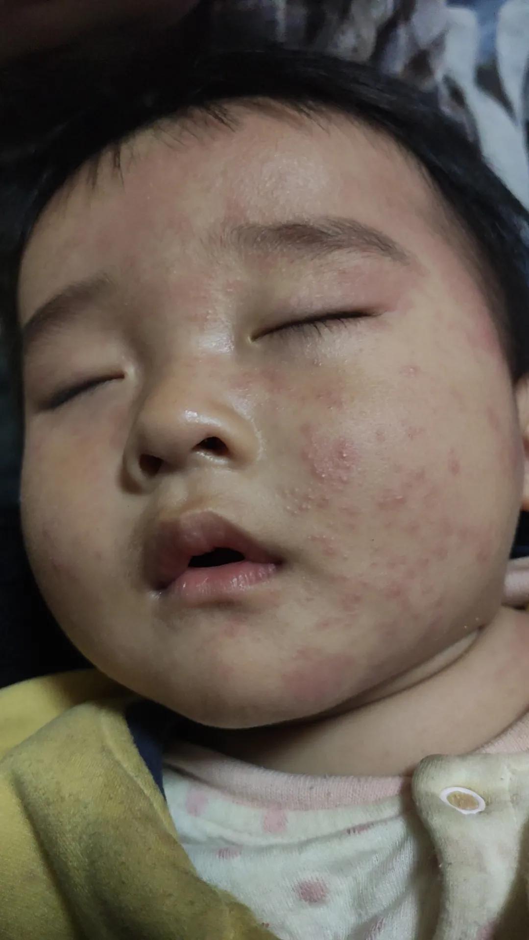 幼儿玫瑰疹的症状,玫瑰疹是幼儿急疹吗