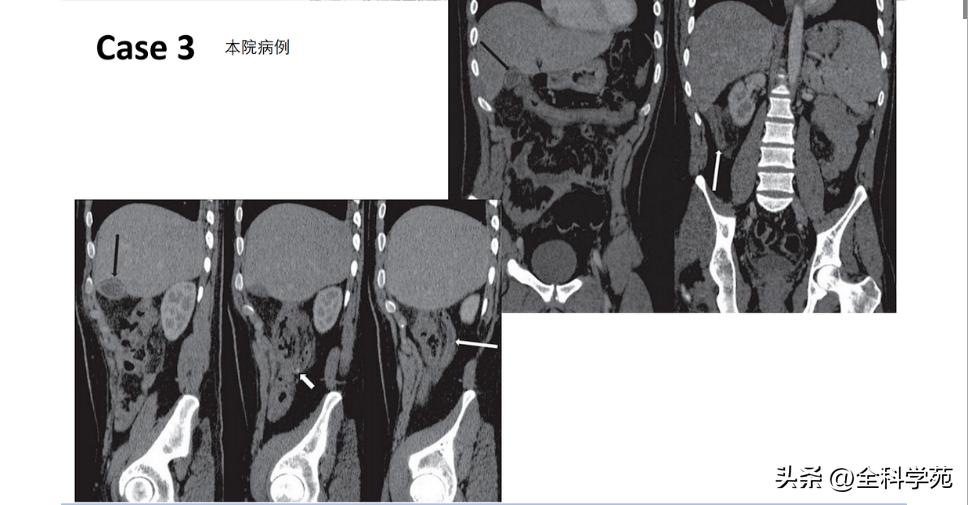 阑尾炎的讲解,关于阑尾炎的讨论总结