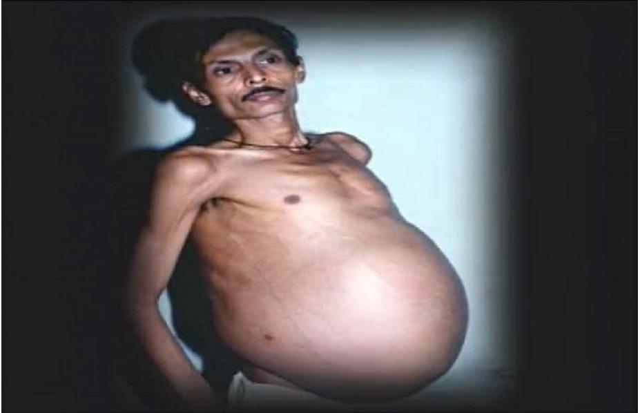 印度小伙意外怀孕,印度男子腹中神秘生物