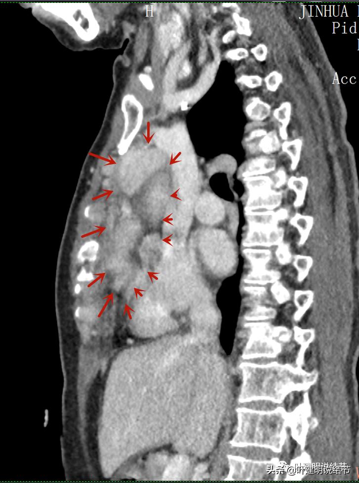 这位老乡，乏力来查，查出这么大个的纵隔肿瘤！会是什么呢？