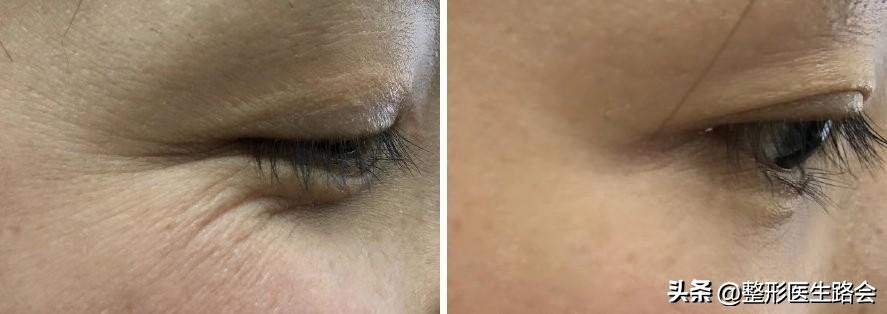 面部暗沉无光泽显老怎么改善,皮肤暗沉皱纹显老