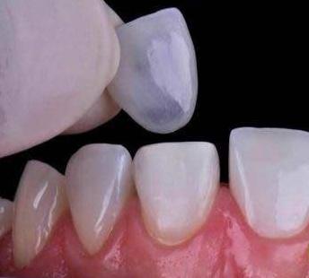 氟斑牙治疗的3种方法,氟斑牙最佳修复方法