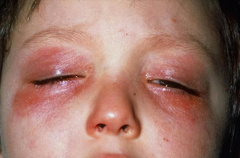 7岁男孩眼球被炸后融化,七岁男童眼睛秒被溶化