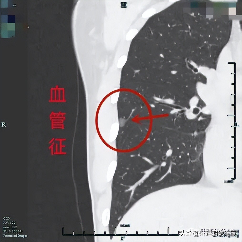 中叶多发微小结节,男性30岁右侧甲状腺单发结节