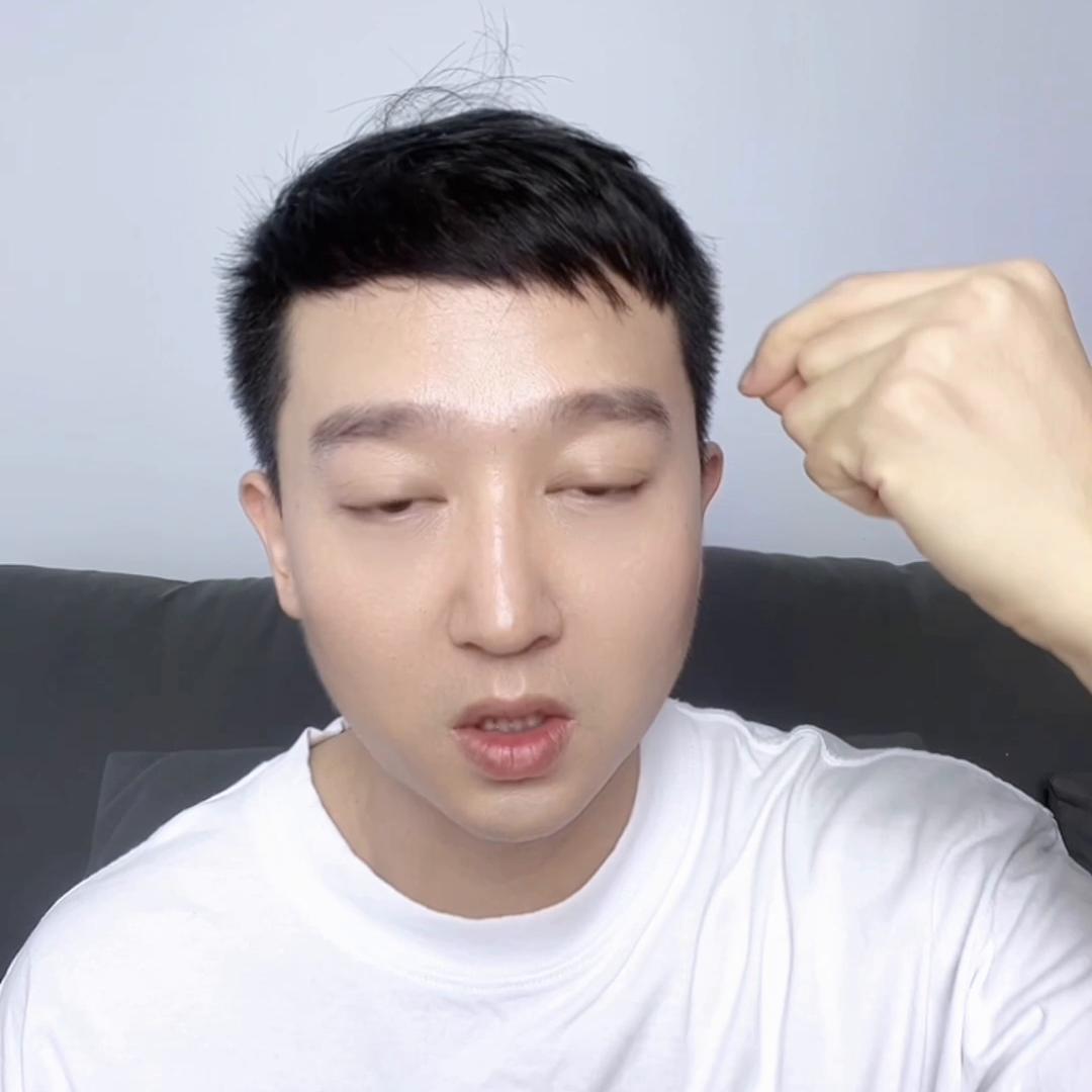 遗传秃头一般什么时候秃,秃头是遗传怎么治疗