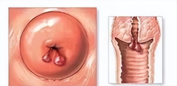 宫颈息肉有必要割掉吗,宫颈息肉需不需要割掉