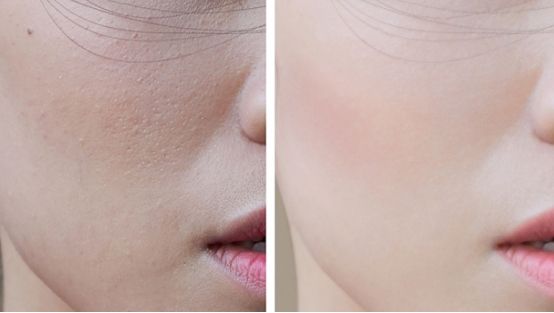 毛孔粗大如何改善小技巧,毛孔粗大如何改善最有效的方法