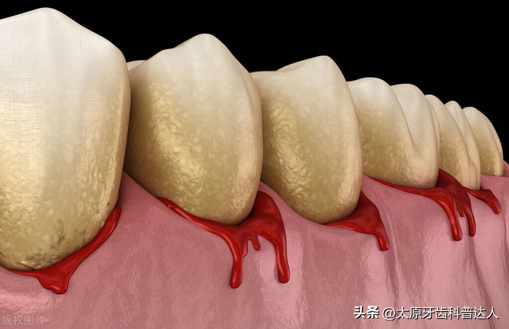 牙周炎是如何让你失去牙齿,如果牙齿有牙周炎怎么办