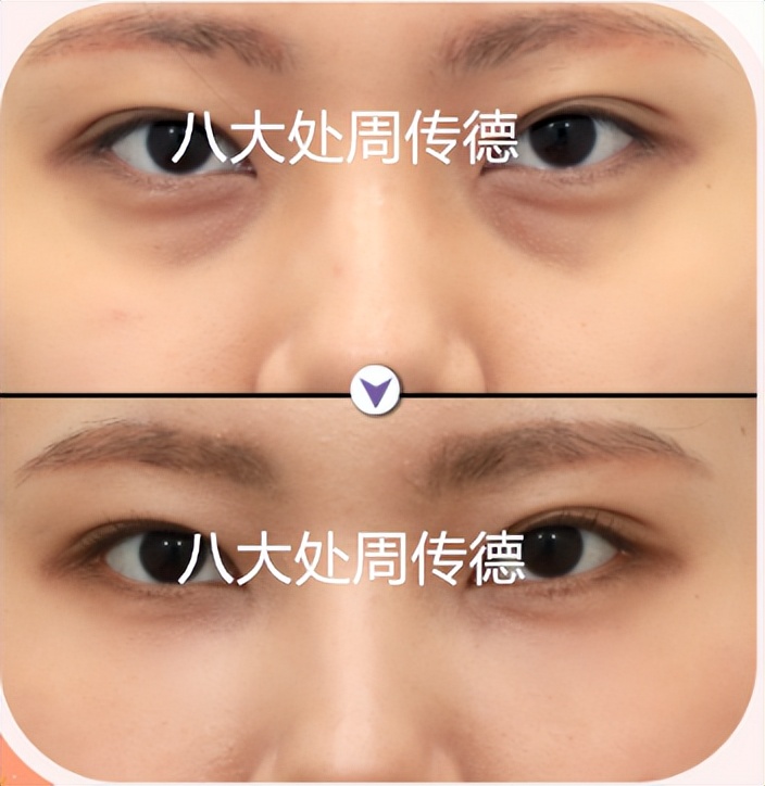 关于祛眼袋的十大误区,祛眼袋医生