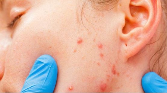 反复长痘痘怎么根除小妙招,长痘痘皮肤快速修复的方法