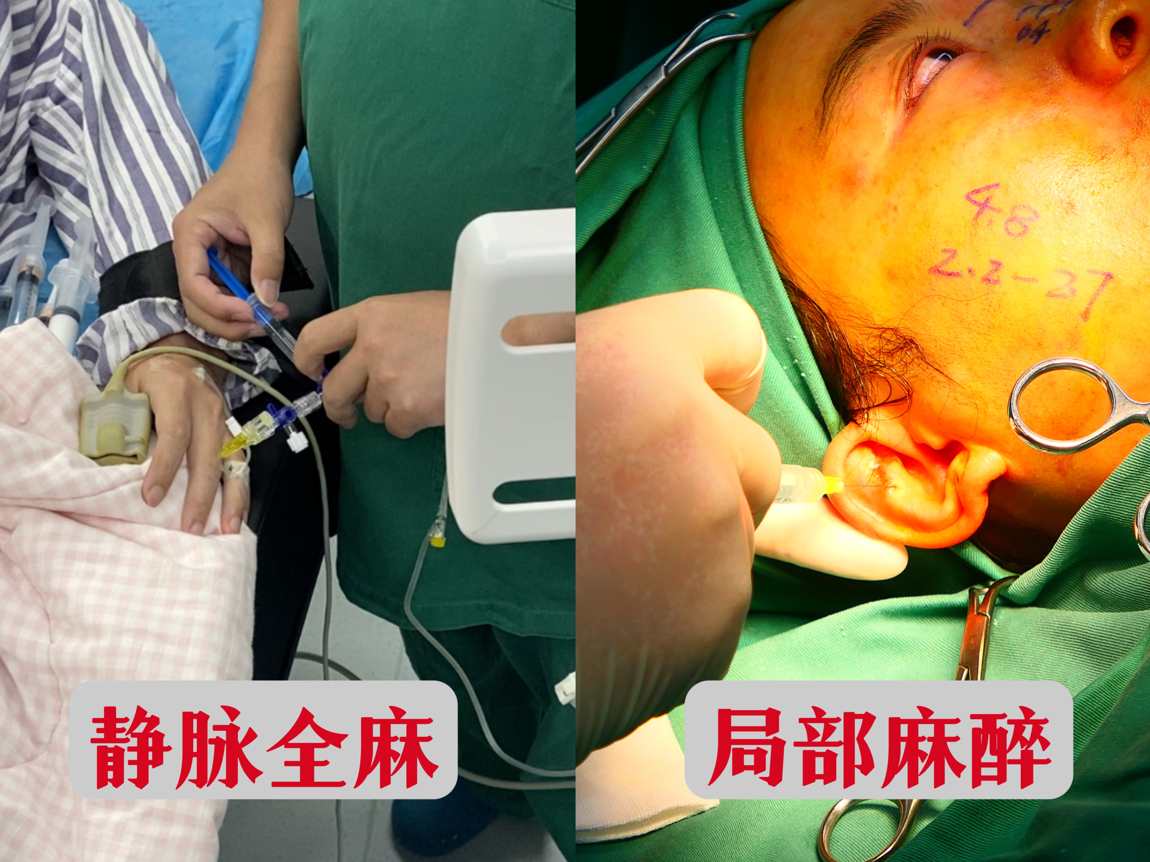 整形隆鼻手术,隆鼻整形全麻手术全过程