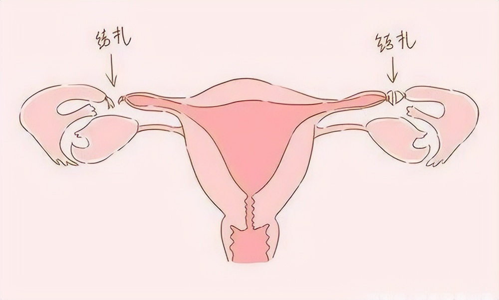 结扎多年了还能怀上吗,结扎多年后想再孕建议哪种方法