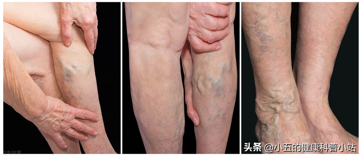 人老腿先衰8个表现预示你已衰老,人老腿先老的三种表现